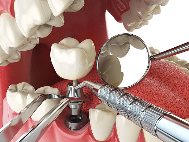 Best Emergency Wisdom Tooth Extraction in Huntgburg, IN